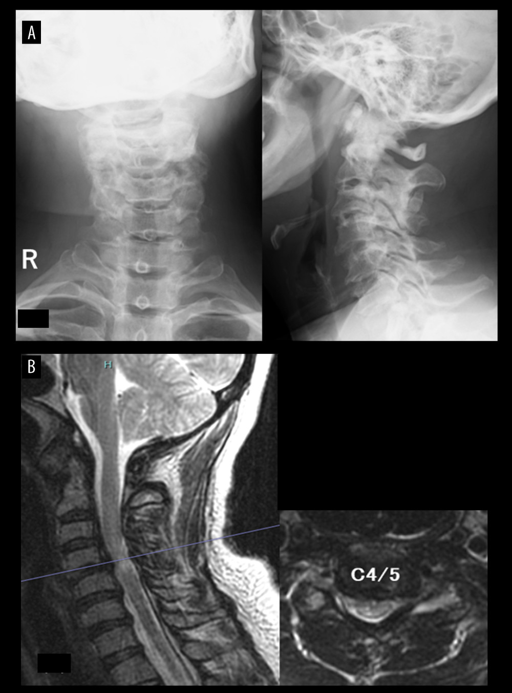 Case 1. A 39-year-old woman with athetoid and dystonic cerebral palsy associated with degenerative cervical spondylotic myelopathy (preoperative findings). (A) Radiography showed cervical deformity. (B) Magnetic resonance imaging showed C4/5 spinal cord signal changes, but the degree of stenosis was mild.