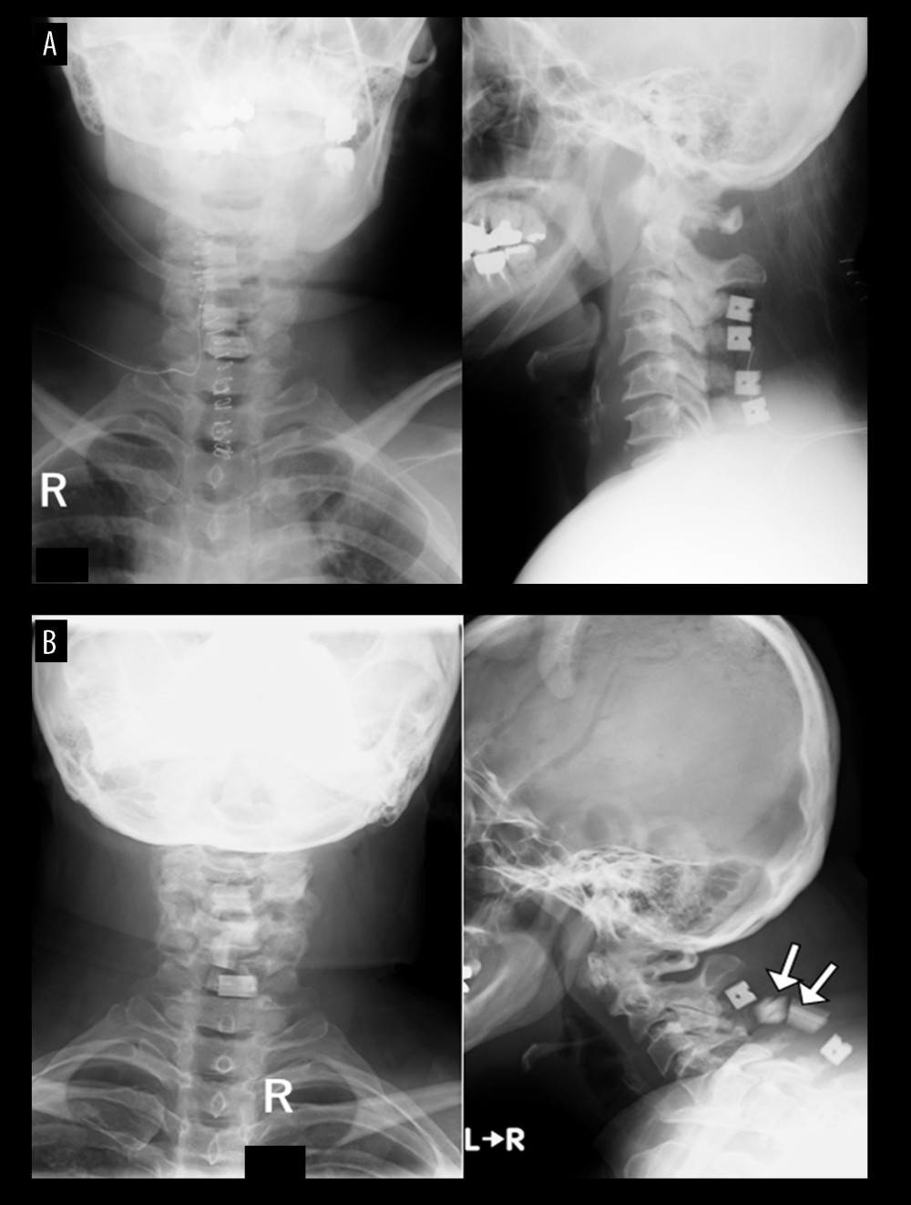 Case 1. A 39-year-old woman with athetoid and dystonic cerebral palsy associated with degenerative cervical spondylotic myelopathy (postoperative findings). (A) The patient underwent C3-C6 laminoplasty. (B) At 4 months after surgery, the C4 and C5 spacers were dislocated (white arrows).
