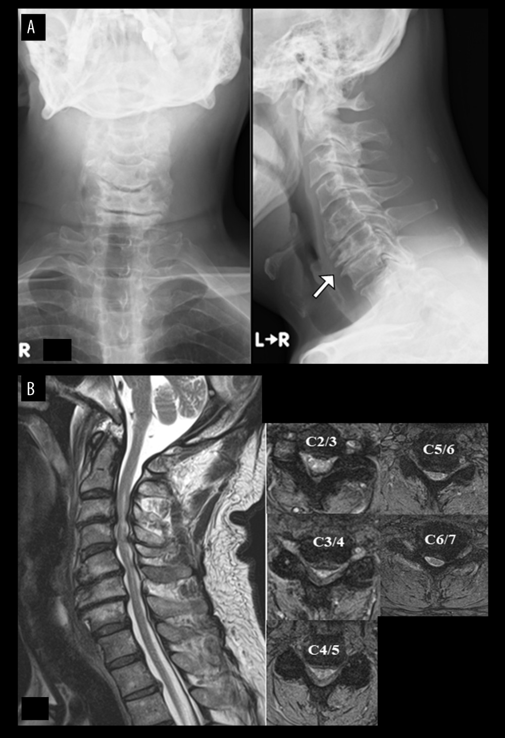 Case 2. A 52-year-old man with athetoid and dystonic cerebral palsy associated with degenerative cervical spondylotic myelopathy (preoperative findings). (A) Radiography showed lower cervical deformity (white arrow). (B) Magnetic resonance imaging showed spinal canal stenosis from C3/4 to C6/7.