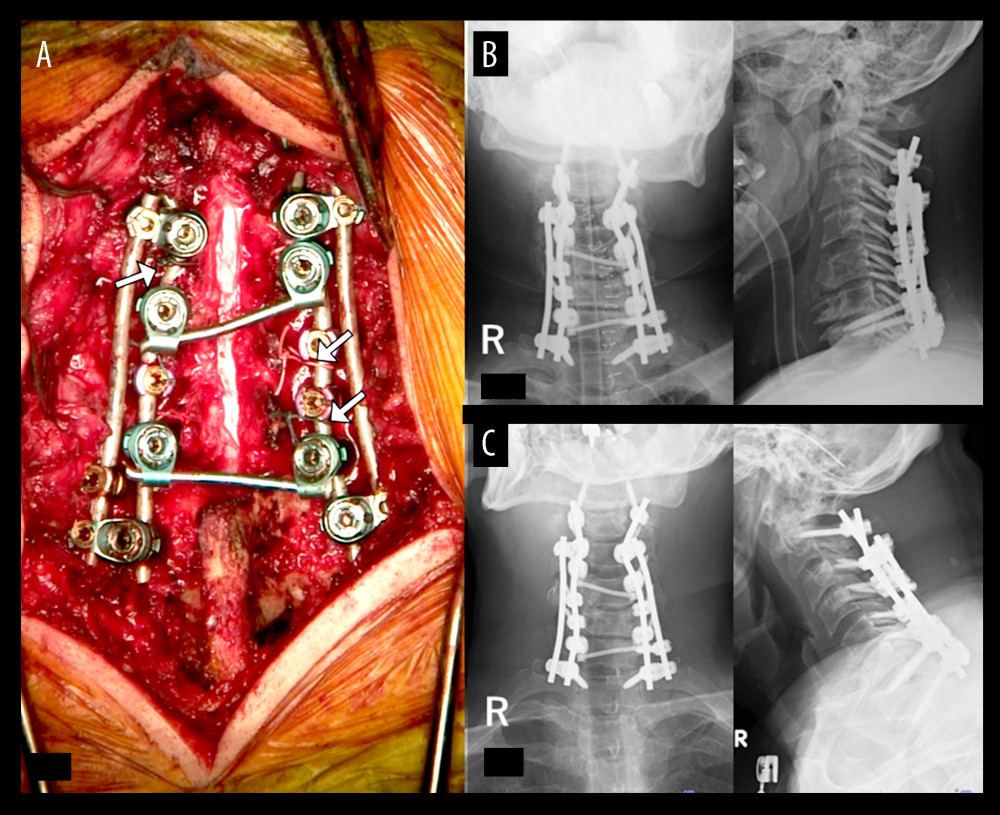 Case 2. A 52-year-old man with athetoid and dystonic cerebral palsy associated with degenerative cervical spondylotic myelopathy (postoperative findings). (A) Intraoperative findings. The split laminae were fixed to rods by tying with nonabsorbable thread (white arrows). (B) C2-T1 posterior fixation, C3 laminectomy, and C4–C6 laminoplasty were conducted. (C) Six months after surgery, no early postoperative implant failure had occurred.
