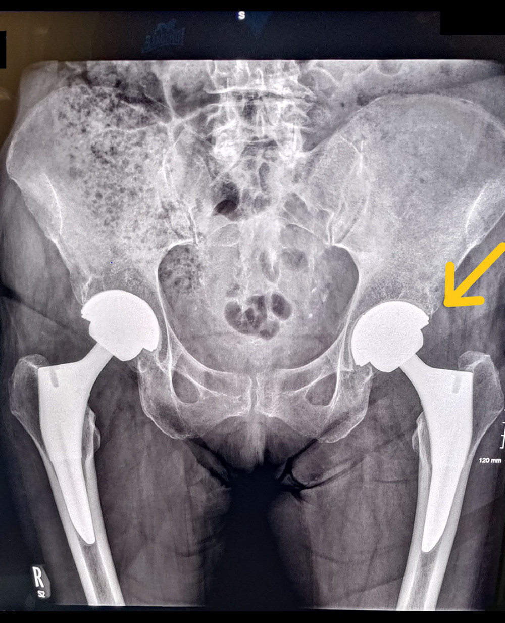 X-ray of day 1 after primary total hip replacement with a ceramic-on-ceramic bearing.
