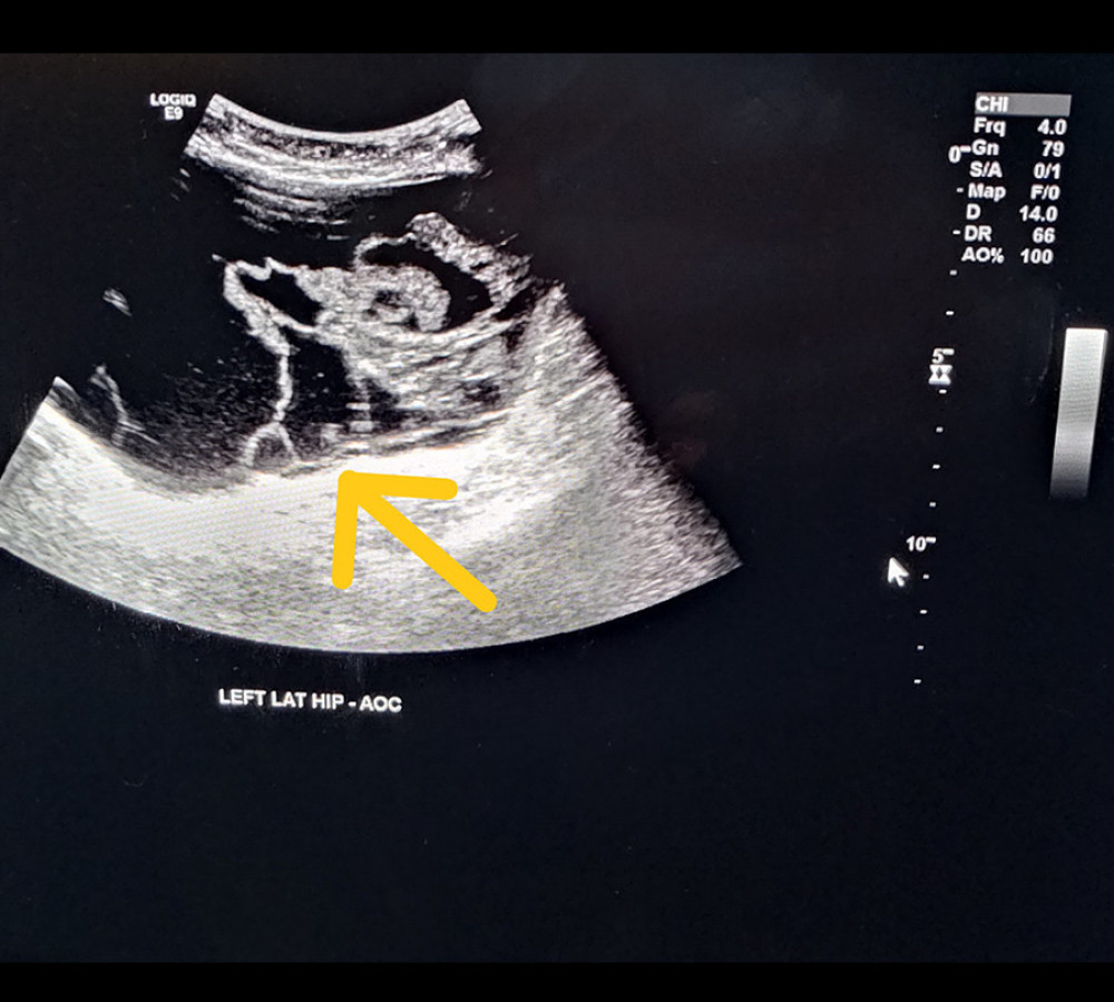 Ultrasound Doppler performed for suspicion of deep venous thrombosis, showing a large pseudotumor mass.