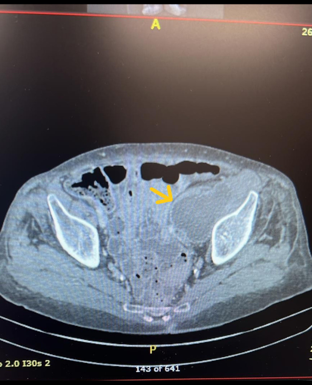 CT venogram showing pseudotumor.