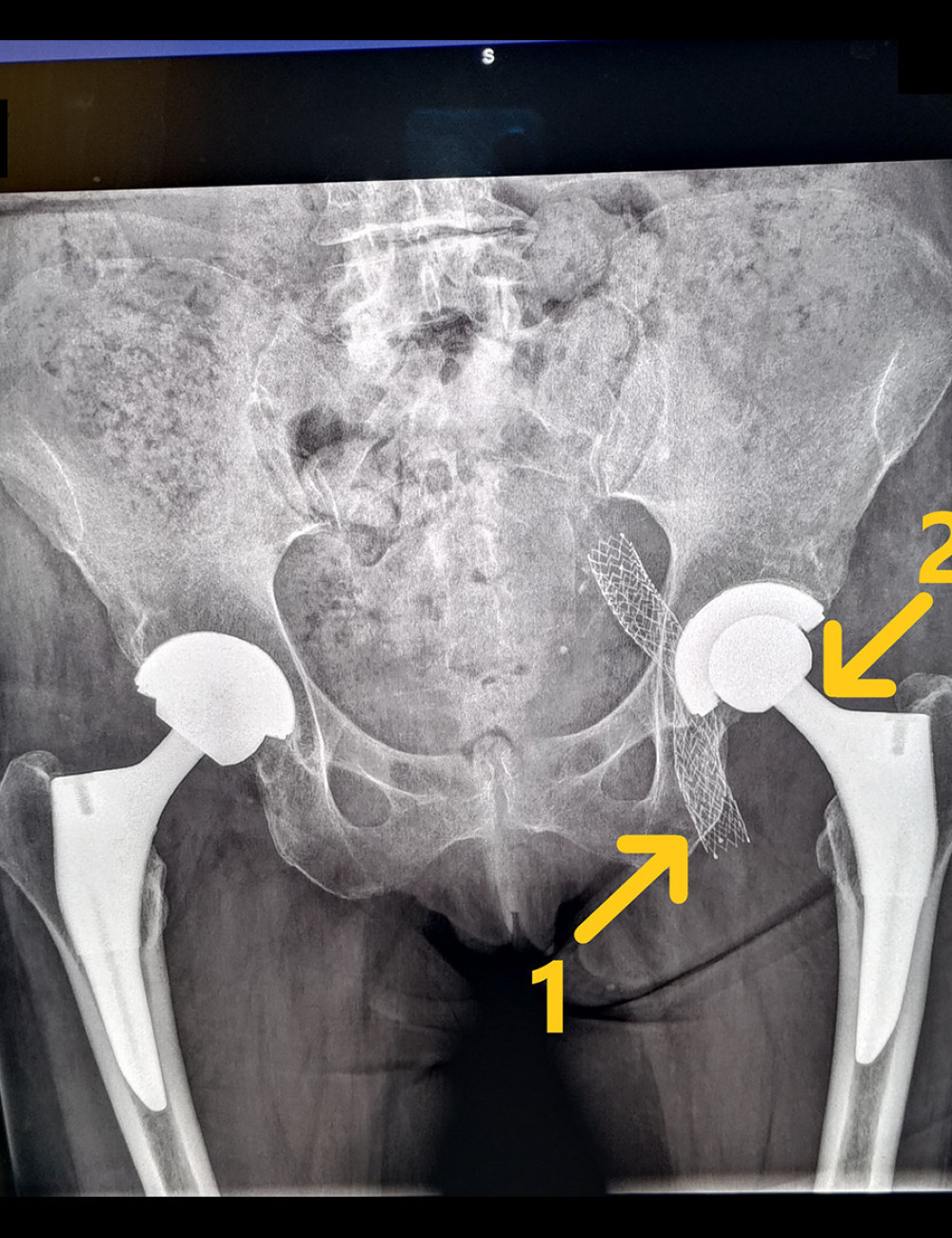 X-Ray day 1 after revision of left total hip replacement, ceramic-on-polyethylene bearing [arrow 2]. Vena cava stent in situ [arrow 1].