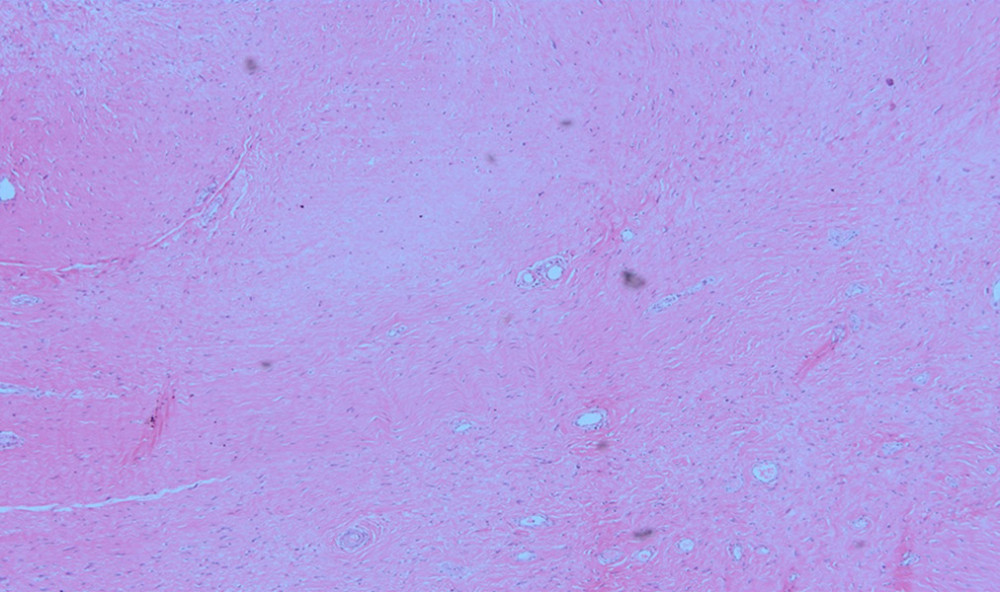 H&E section 10×. Area of hyaline fibrous tissue. Pseudotumor.