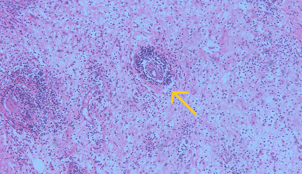 H&E section 10×. Edematous area with perivascular lymphocytic infiltration. pseudotumor.