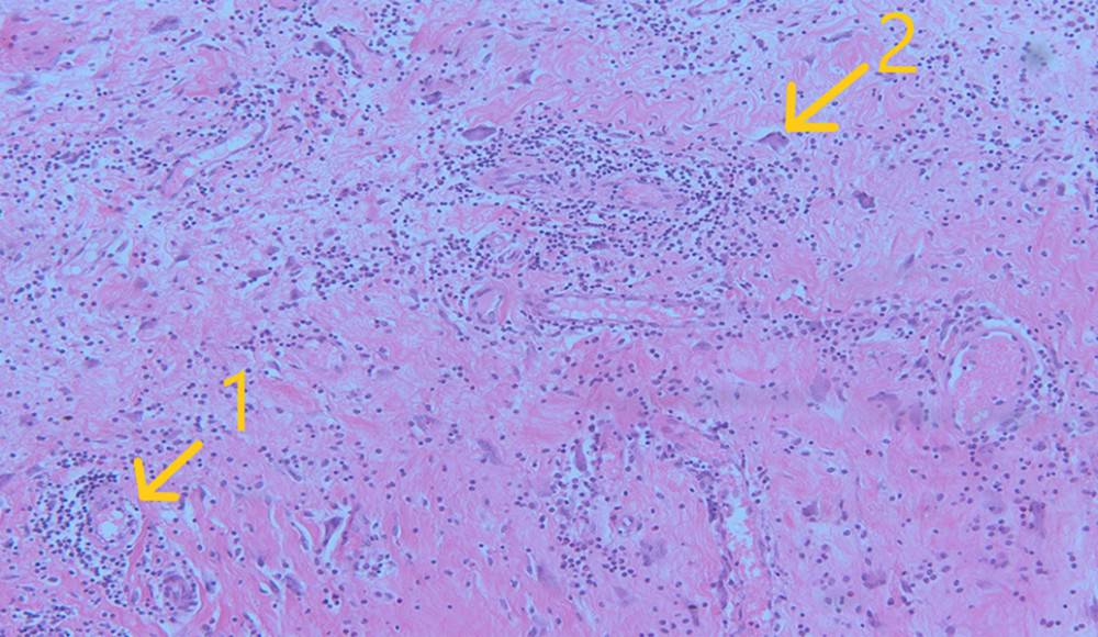 H&E section 10×. Diffuse and perivascular inflammation [arrow 1] with scattered multinuclear giant cells [arrow 2].