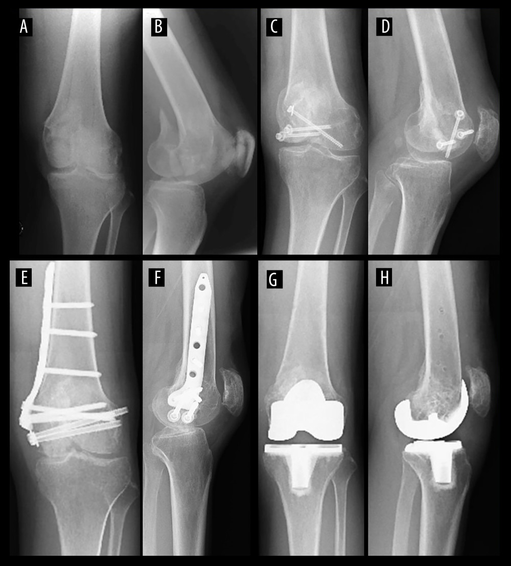 Case 1: Hoffa’s fracture to TKA X-rays. (A, B) Anteroposterior (AP) and lateral radiographs of initial injury. (C, D) AP and lateral radiographs of Hoffa’s fracture treated with primary open reduction and internal fixation. (E, F) AP and lateral radiographs after reoperation for nonunion and before Total Knee Arthroplasty (TKA). (G, H) AP and lateral radiographs after TKA.