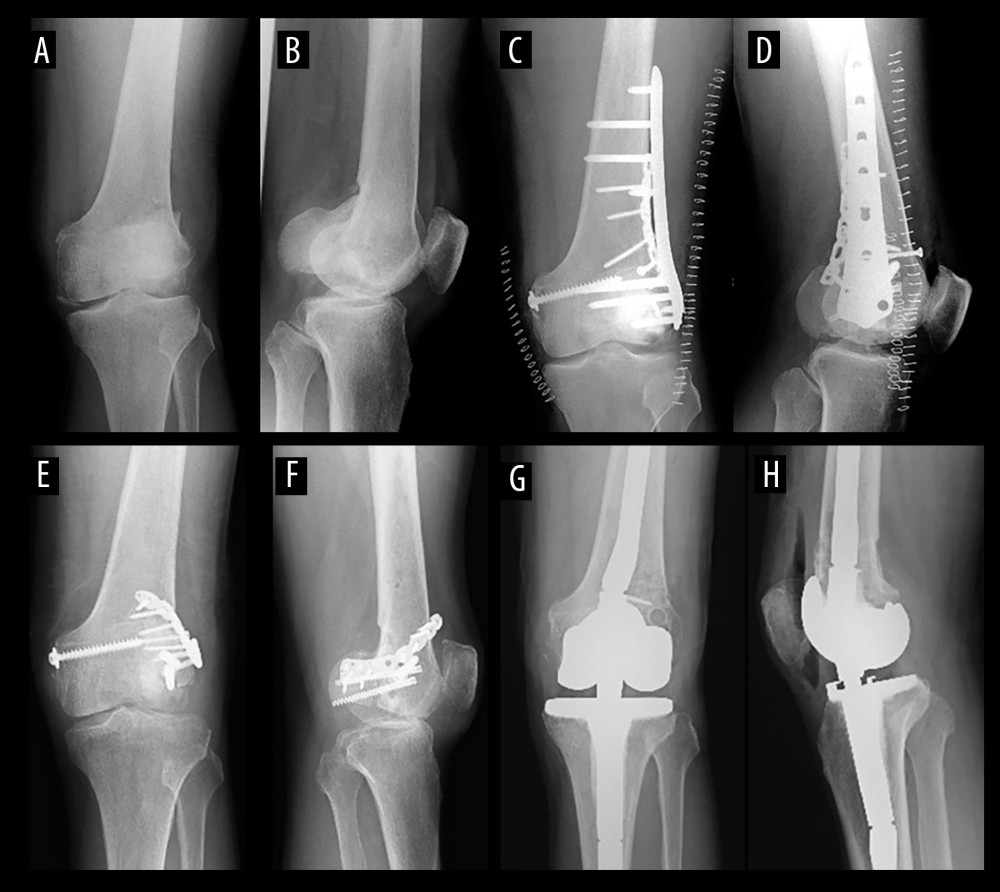 Case 2: Hoffa’s fracture to TKA X-rays. (A, B) Anteroposterior (AP) and lateral radiographs of initial injury. (C, D) AP and lateral radiographs of Hoffa’s fracture treated with primary open reduction and internal fixation. (E, F) AP and lateral radiographs of after reoperation for nonunion and before total knee arthroplasty (TKA). (G, H) AP and lateral radiographs showing Case 2’s long-stem hinge-type TKA.
