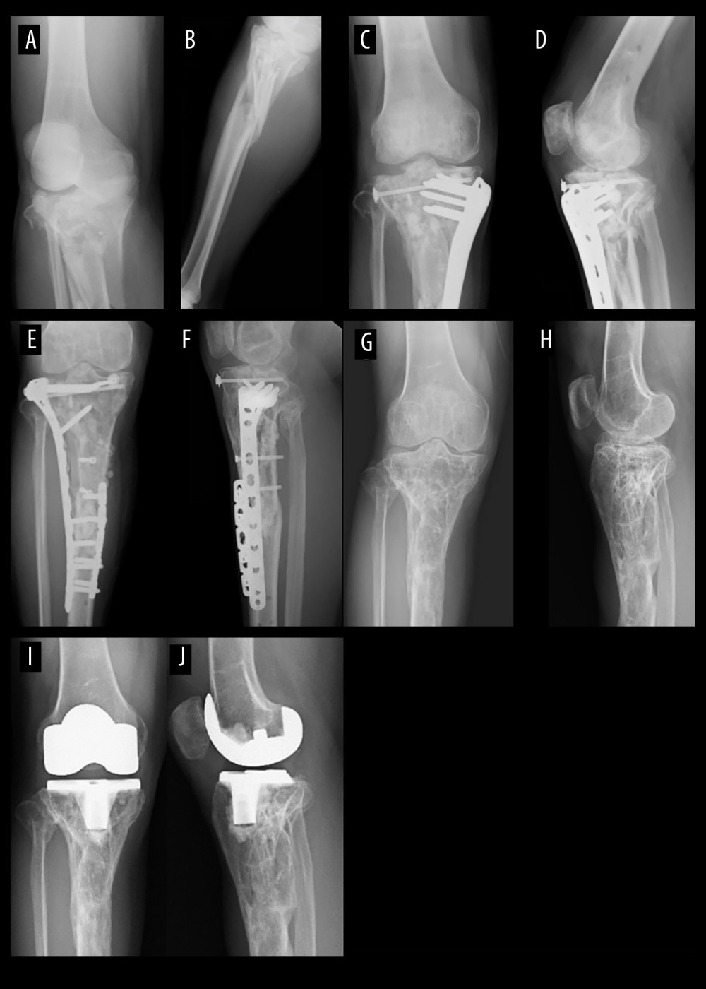 Case 3: Proximal tibial fracture to TKA X-rays. (A, B) Anteroposterior (AP) and lateral radiographs of initial injury. (C, D) AP and lateral radiographs of proximal tibial fracture treated with primary open reduction and internal fixation. (E, F) AP and lateral radiographs of reoperation for infected nonunion. (G, H) AP and lateral radiographs after screw and plate removal and before total knee arthroplasty (TKA). (I, J) AP and lateral radiographs after TKA.