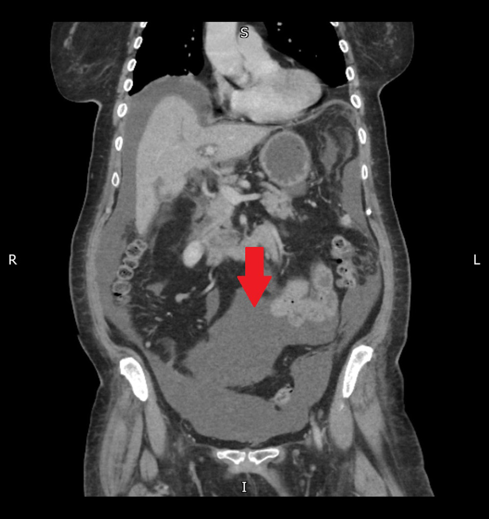 A repeat computed tomography (CT) scan of the abdomen and pelvis displaying large-volume abdominopelvic ascites, of no obvious source.