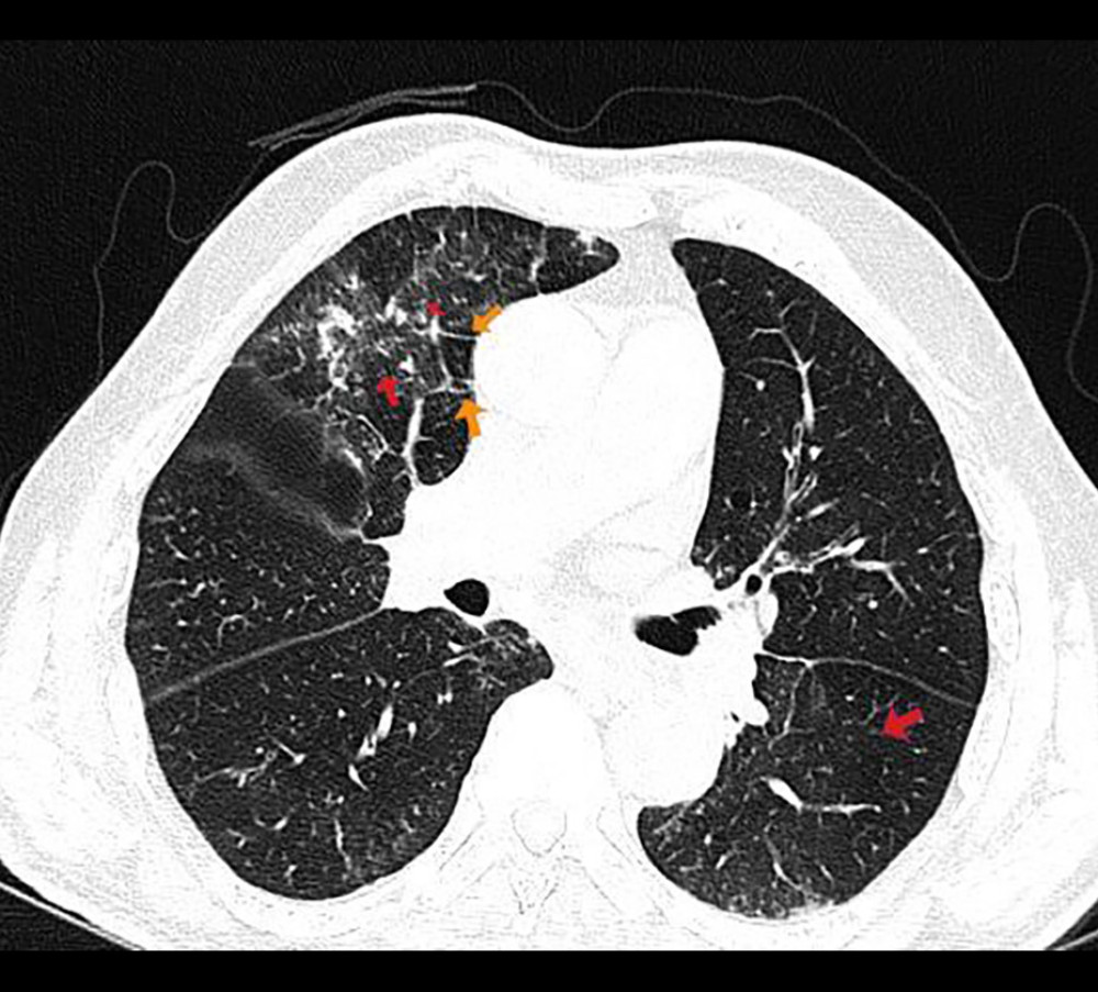A transverse thoracic computed tomography (CT) image of an 85-year-old man with cough and dyspnea. Multiple clusters of centrilobular nodules with surrounding ground-glass opacities are seen in B/L upper lobes (superior segment of right lower lobe and left lower lobe) shown by red arrow. Smooth interlobular septal thickening surrounding lung parenchyma shown by yellow arrow. No evidence of tumor or lung fibrosis is seen.