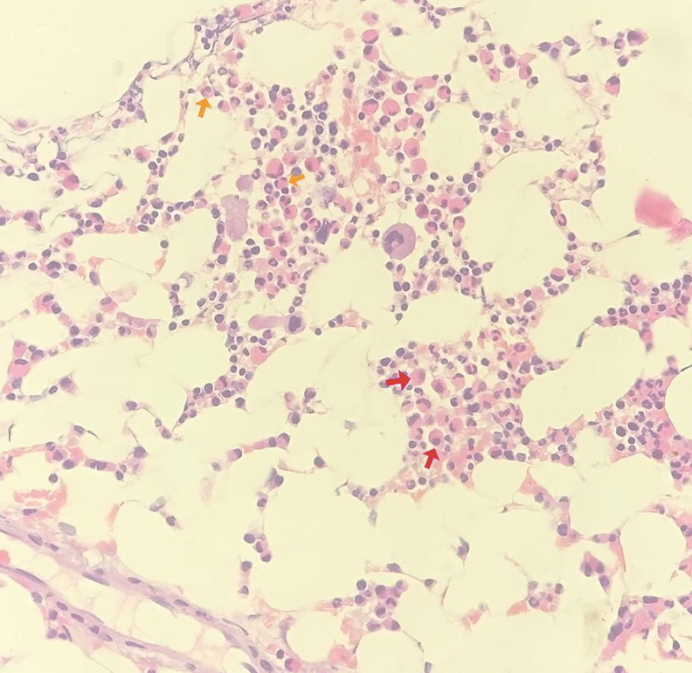 A photomicrograph of the bone marrow aspiration from an 85-year-old man shows Myeloid predominance with prominence of eosinophils (yellow arrow) and eosinophilic precursors (red arrow).