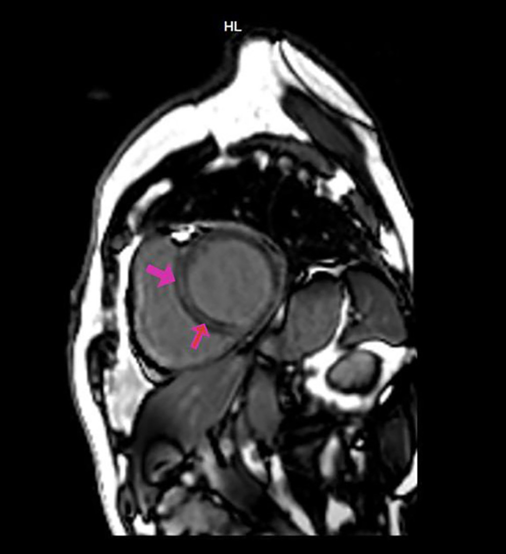 Cardiac magnetic resonance imaging (MRI) with gadolinium enhancement from an 85-year-old man with idiopathic hypereosinophilic syndrome. The short axis view of the left ventricle at the level of the papillary muscle shows late gadolinium enhancement of the subendocardial region of lateral left ventricular wall and mid-myocardial enhancement in the midseptum (red arrow).