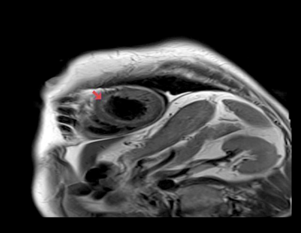 Cardiac T2 magnetic resonance imaging (MRI) with gadolinium enhancement from an 85-year-old man with idiopathic hypereosinophilic syndrome. The short axis view of the left ventricle shows enhancement of septal subendocardial region (red arrow).