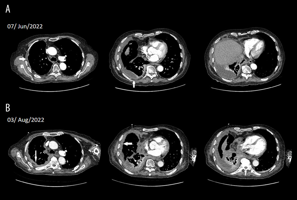 Thoracic computed tomography (CT) illustrating the rapid progression of pleural thickening over a period of 8 weeks, with new pleural nodularity. Both of the CT scans were taken after draining most of the pleural effusion. (A) Minimal right-sided diffuse pleural thickening on the initial CT Scan (→, ↓), with presence of pleural effusion. (B) lobular thickening of the pleura on the right side with significant progression (↑, ←), along with pleural effusion.
