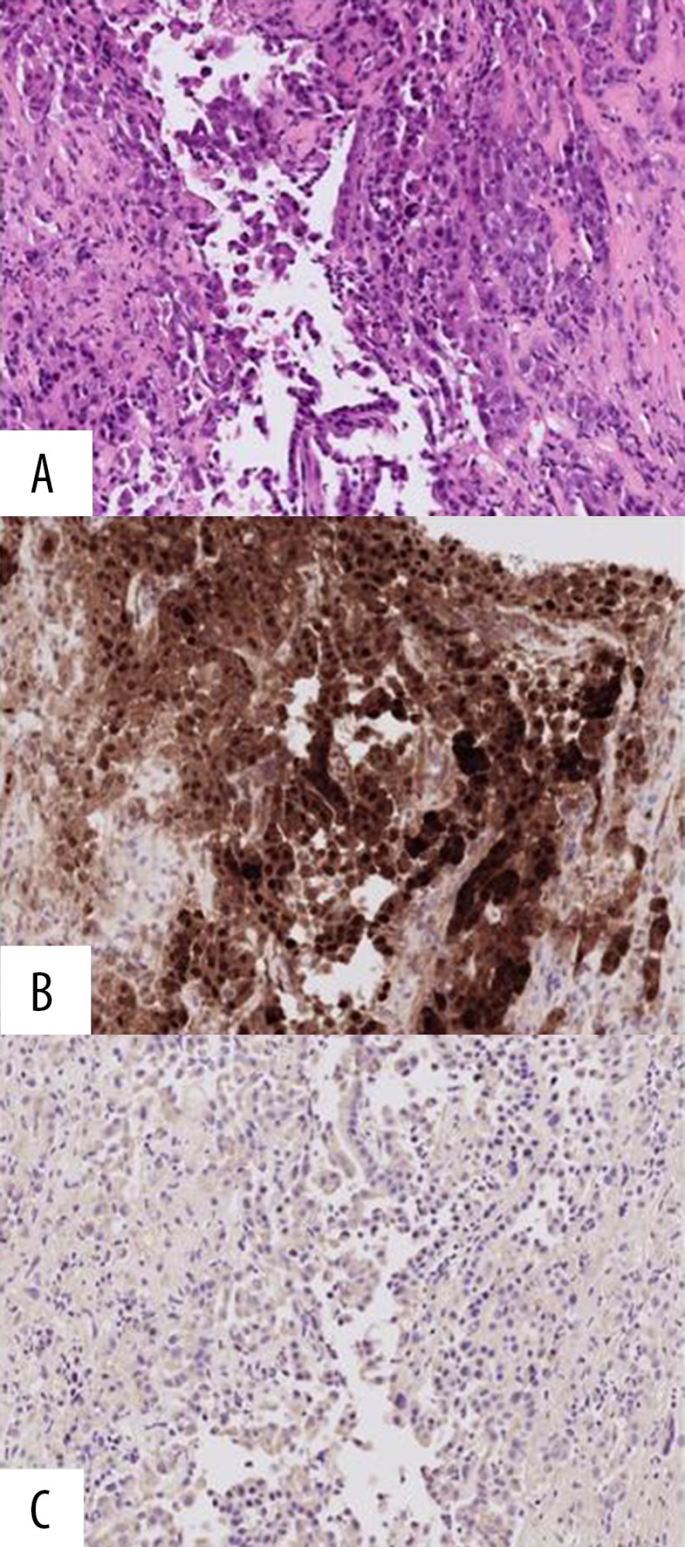Histopathology of the pleural biopsy showing atypical mesothelial proliferation, with an immunohistochemistry panel that confirm the diagnosis of mesothelioma. (A) The hematoxylin and eosin staining shows atypical mesothelial proliferation, in keeping with an epithelioid mesothelioma (×20). (B) Immunohistochemistry panel showing positive calretinin, which confirmed the diagnosis of mesothelioma (×20). (C) Immunohistochemistry panel showing negative BerEp4, which excluded the presence of pulmonary adenocarcinoma (×20).