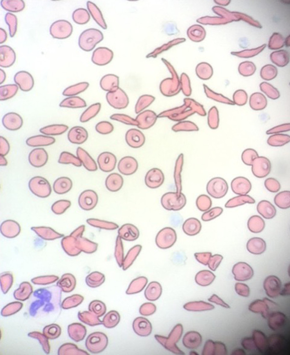 Photomicrograph of red blood cell (RBC) morphology from sickle cell disease SS (not this patient). Wrights-Giemsa stain. 40×. Photo by author. A few RBCs have the crescent shape that is classically described as a “sickled cell.” About half of the RBCs are elongated but not crescents. About half of the RBCs are round, with the normal biconcave disc shape. This variation in RBC shape could represent ex vivo oxygenation, dehydration, or other conditions outside the body. A normal neutrophil is seen at the lower left corner. Normal platelets are present but out of focus in this image.