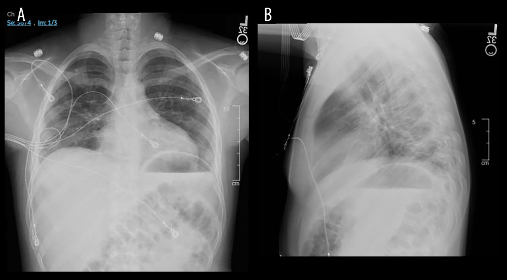 Chest X-ray upon hospital admission: (A), frontal view, and (B), lateral view. Radiology report was “Negative for focal pulmonary consolidation, pleural effusion, pneumothorax. Pulmonary vasculature is within normal limits. Borderline cardiomegaly. Likely cholelithiasis. H-shaped vertebral bodies reflecting chronic sickle cell changes.”