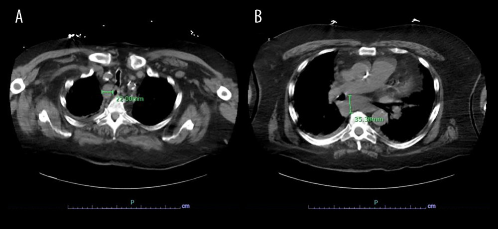 CT chest showing right upper para-tracheal adenopathy with nodes measuring up to 2.2 cm in the short axis (A) and subcarinal adenopathy measuring up to 3.5 cm in the short axis (B).