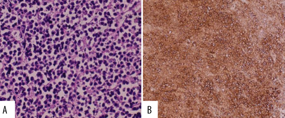 Section of the liver showing sheets of large lymphoid cells (A) ×400. The cells are strongly positive for CD20 (B) ×400.