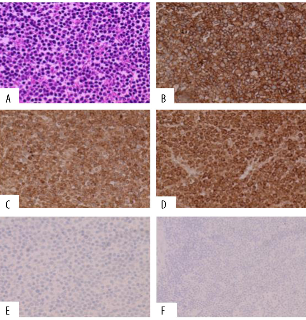 Sections of tan brown right hilar mass (matted lymph nodes) show diffuse sheets of neoplastic large lymphoid cells (A ×400) that show positivity for CD20, BCL2, and CD10 (B–D ×400). The cells are negative for cyclin D1 and BCL6 (E ×400, F ×200).