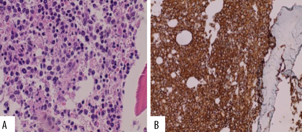 Bone marrow shows diffuse effacement of the architecture by sheets of large lymphoid cells (A ×400 mag) that are positive for CD20 (B ×400 mag).