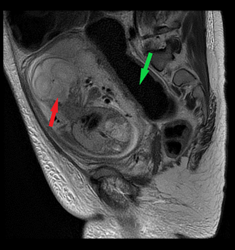 In the abdominal MRI of the patient, enlarged loops of the colon (green arrow) and a single fetus in the uterine cavity (red arrow) are visible.