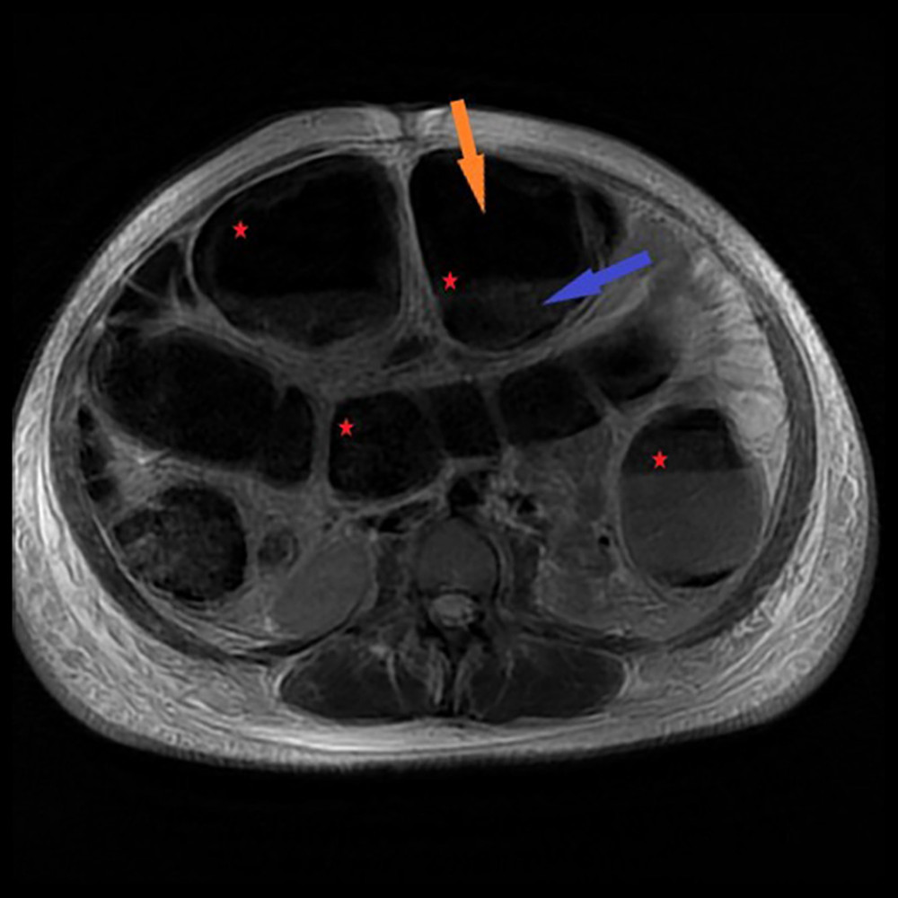 Dilated loops of the large intestine (red stars) with visible fluid (blue arrow) and gas (orange arrow) levels.