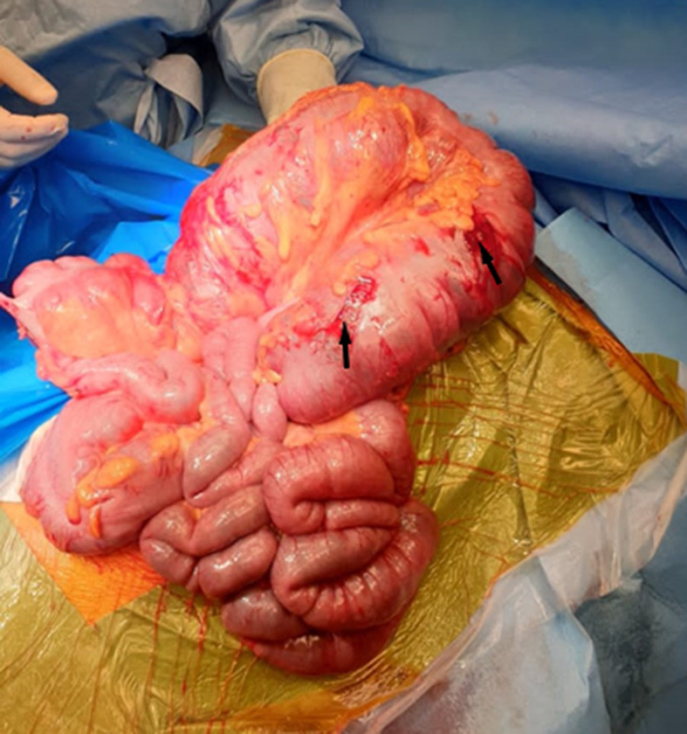 Dilatation of the loops of the large intestine from the splenic flexure to the sigmoid colon. Multiple ruptures of the serosal membrane are present (black arrows).
