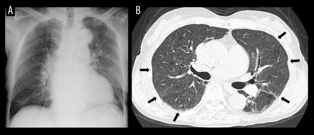 Chest radiography and computed tomography images on admission. (A) Chest radiography. (B) Chest computed tomography. Both images show bilateral diffuse ground-glass opacities (arrows).