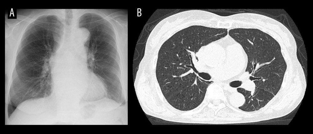 Chest radiography and computed tomography images on the 30th day after admission. (A) Chest radiography. (B) Chest computed tomography. Both images show improvement in bilateral diffuse ground-glass opacities.