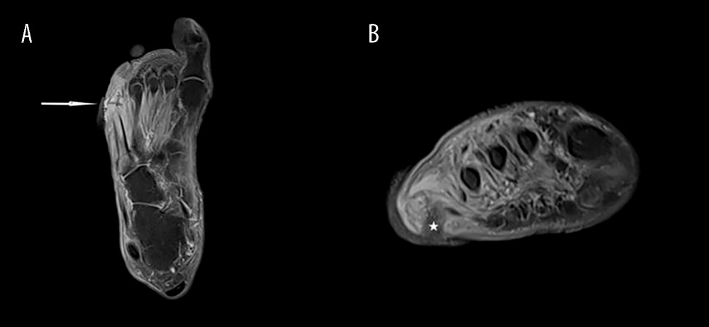 MRI scans of the left lower foot. (A) Contrast-enhanced T1-weighted fat saturation MRI in the coronal plane of the foot shows marked contrast enhancement of the distal fifth metatarsal bone and proximal phalanx with signs of early destruction of the articular surfaces of the metatarso-phalangeal joint space (white arrow). There was also prominent contrast enhancement of the plantar and dorsal muscles of the foot extending from the fifth to the second toe suggestive of extensive myositis. (B) Contrast-enhanced T1-weighted fat saturation MRI in the axial plane of the foot. The axial image showed a sinus tract extending to a subcutaneous abscess adjacent to the base of the fifth metatarsal bone, with an overlying skin ulcer (asterisk). MRI – magnetic resonance imaging.