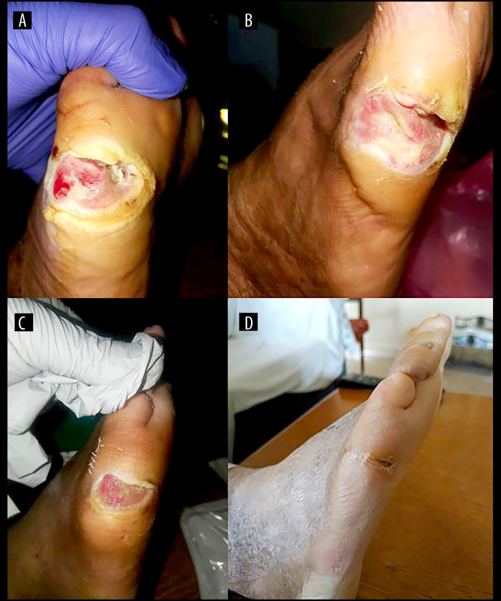 Progression of wound healing of the DFU: (A) 4 weeks; (B) 6 weeks; (C) 8 weeks; (D) 10 weeks after the beginning of antimicrobial therapy. DFU – diabetic foot ulcer.