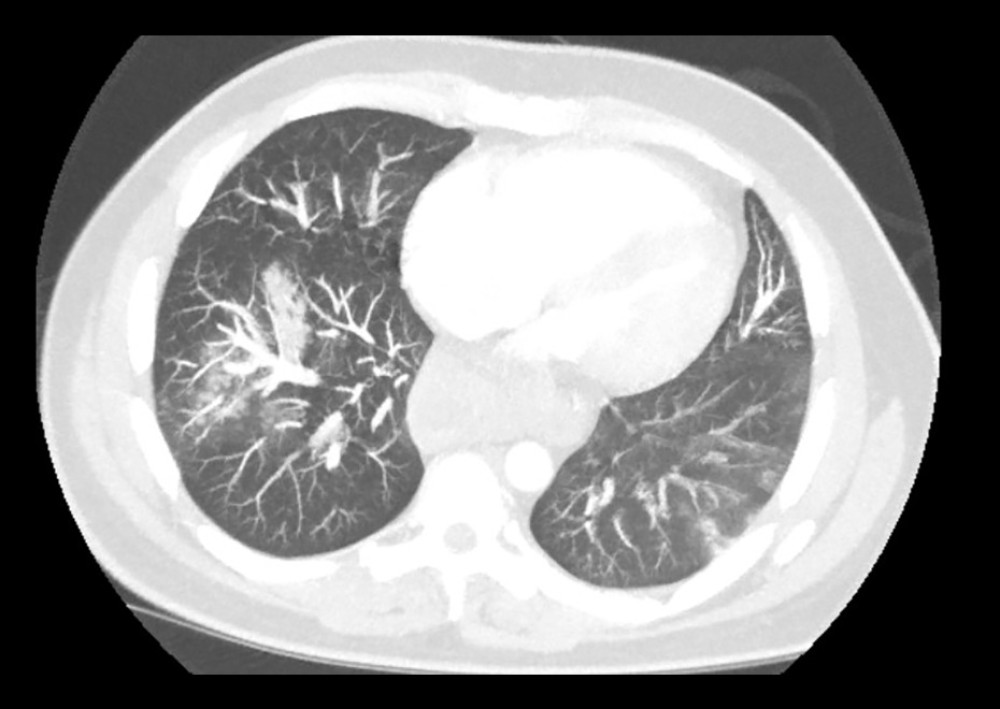 Computed tomography pulmonary angiogram showing right-sided patchy-white pulmonary infarcts and infiltrates in the right upper and lower lobes.