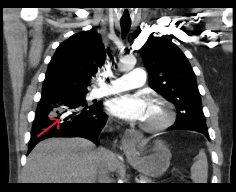 Computed tomography pulmonary angiogram with the arrow showing lobar, segmental and subsegmental pulmonary emboli, right heart strain, and subsegmental pulmonary infarct in the posterolateral left lower lobe.