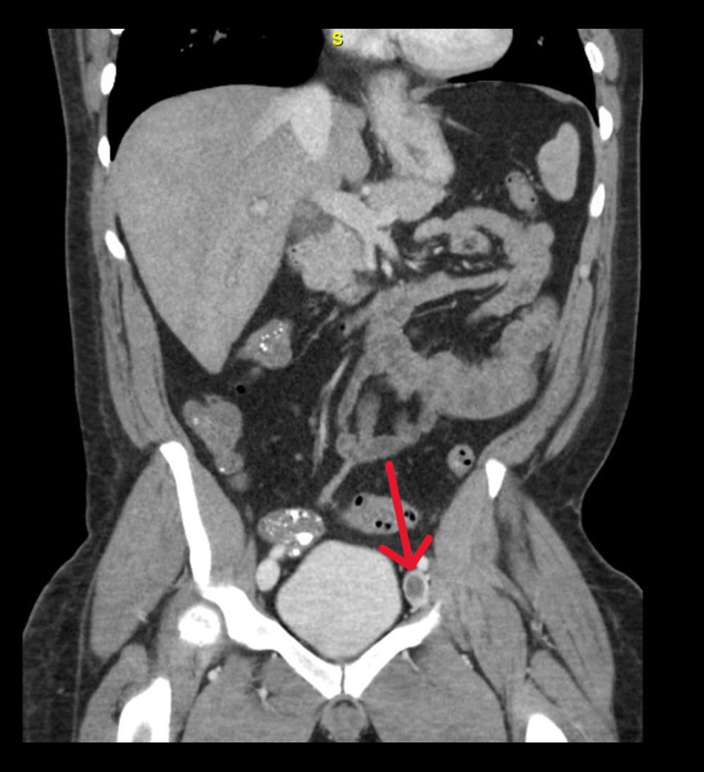 Computed tomography of the abdomen and pelvis with intravenous contrast with the arrow showing a left iliac vein clot.
