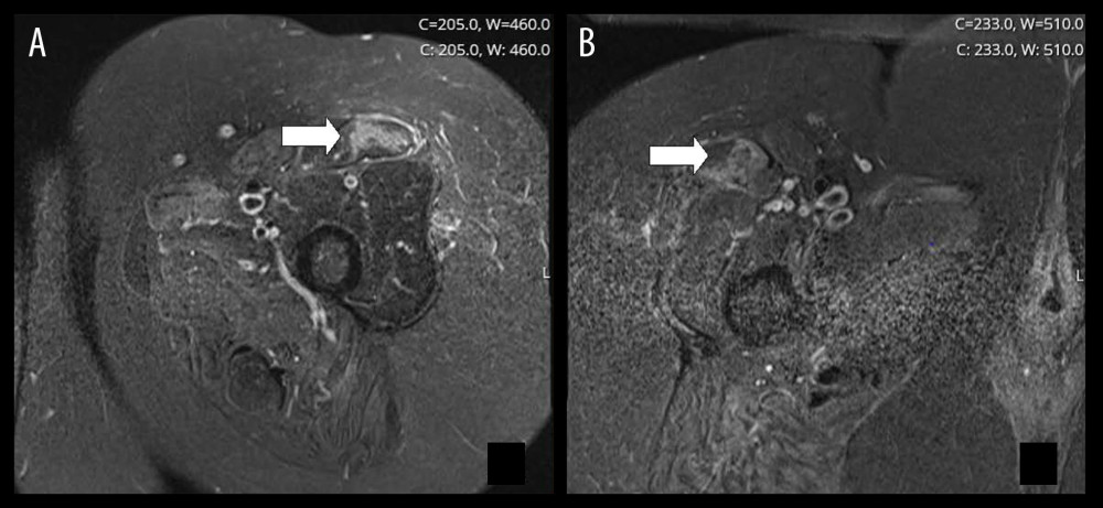 Statin-induced myositis - axial STIR images of the rectus femoris muscles of the mid-thighs (A-left, B-right) reveal heterogeneous hyper-intense signal affecting all compartments. Axial proton density with fat saturation reveals an abnormal area of increased signal intensity that corresponds to edema as indicated by white arrows. STIR, short T1 inversion recovery (magnetic resonance testing).