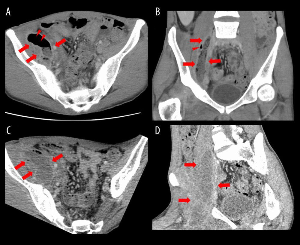 Abdominal computed tomography with contrast enhancement findings. (A) Horizontal section image at the time of admission. (B) Coronal section image on admission. (C) Horizontal section image on day 19. (D) Coronal section image on day 19. On admission, abdominal computed tomography (CT) with contrast enhancement showed a large low-density area in the right psoas muscle with ring enhancement around it (A, B; arrows) and air density areas inside it (A, B; arrows), suggesting a large, gas-producing right iliopsoas muscle abscess (IMA). Abdominal CT with contrast enhancement on day 19 revealed the reappearance of the right IMA after drainage tube removal (C, D; arrows).