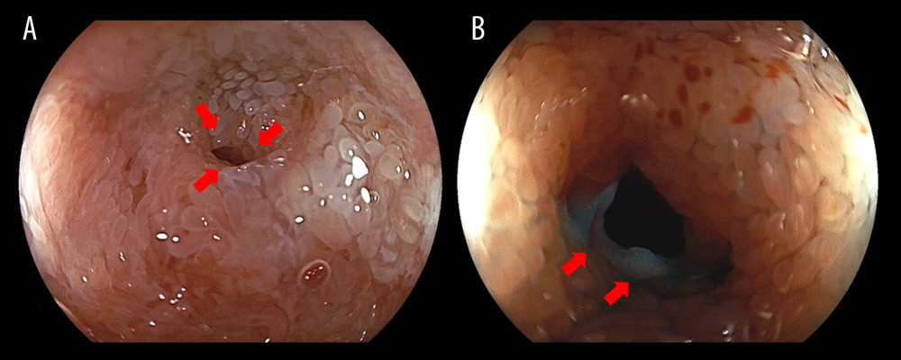 Findings of the lower intestinal tract endoscopy. Ileocolonoscopy revealed a severe stenosis (A, arrows) with circumferential ulceration (B, arrows) in the terminal ileum.