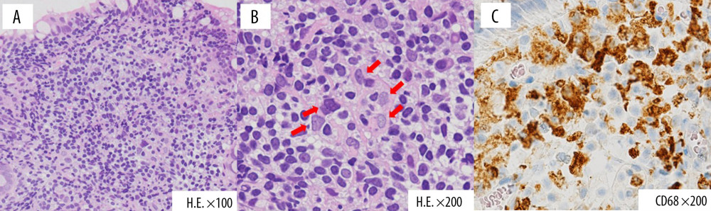 Histopathological findings of the biopsy specimens from the terminal ileum. (A) Hematoxylin and eosin staining (100×). (B) Hematoxylin and eosin staining (200×). (C) CD68 immunostaining (200×). Hematoxylin and eosin staining of the terminal ileum showed infiltration of lymphocytes or plasmacytes into the lamina propria (arrows). In addition, histological findings showed aggregation of CD68-positive histocytes.