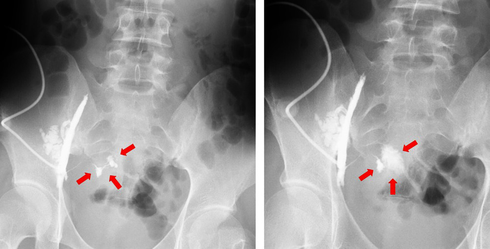 Findings of the third attempt at contrast radiography of the abscess through the drainage tube. The third round of contrast radiography of the abscess through the drainage tube revealed the flow of contrast medium into the small intestine (arrows).