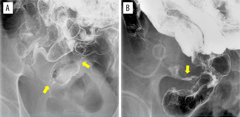 Barium enema findings on the second attempt. The second barium enema showed multiple stenoses (A, arrows) with leakage of the contrast medium outside the bowel in the ileocecal region (B, arrows).