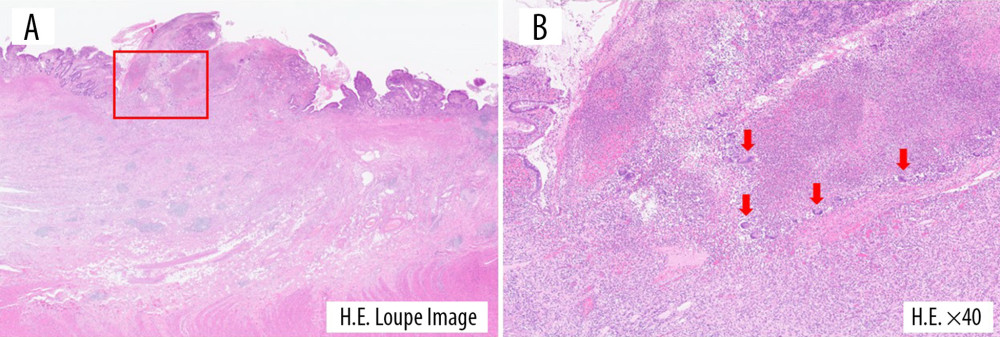 Histopathological findings of the resected ileocecal specimens. Hematoxylin and eosin staining (A: loupe image, B: 40×). The loupe image shows transmural infiltration of inflammatory cells with significant fibrosis. The high-power field image (40×) shows abscess formation containing multinucleated giant cells (arrows) in mucosal layer.