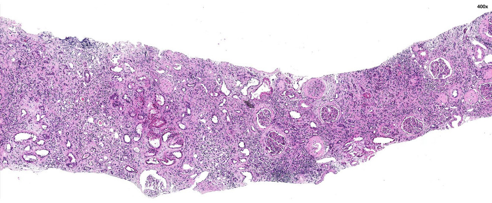 Kidney biopsy with marked interstitial fibrosis and tubular atrophy (IFTA) with areas of chronic interstitial inflammation (hematoxylin-eosin stain).