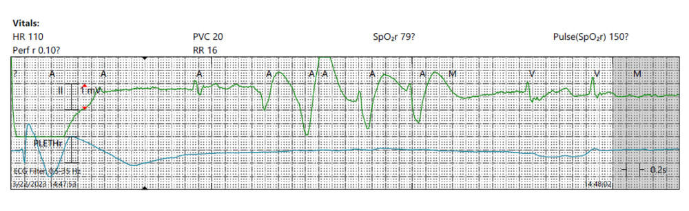 Patient’s telemetry strip depicting a non-sustained polymorphic ventricular tachycardia prior to her undergoing cardioversion.