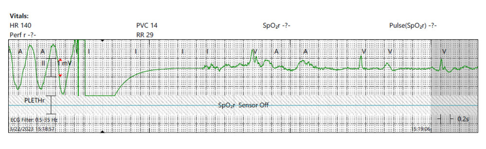 Patient’s telemetry strip depicting ventricular tachycardia, with subsequent cardioversion.