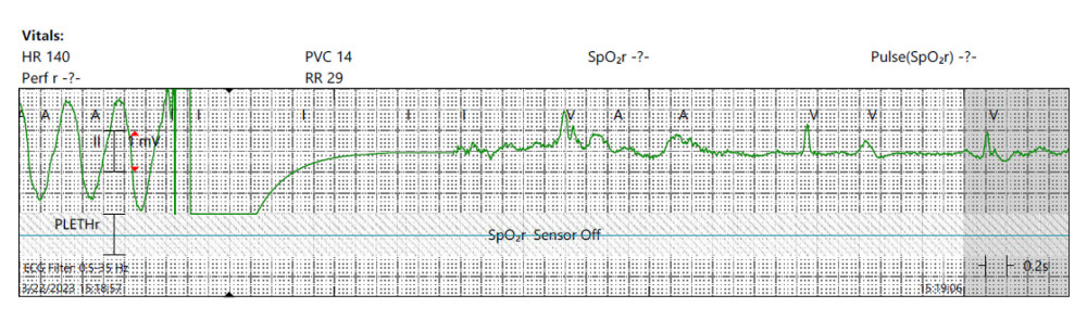 Patient’s telemetry strip depicting ventricular tachycardia, with subsequent cardioversion.