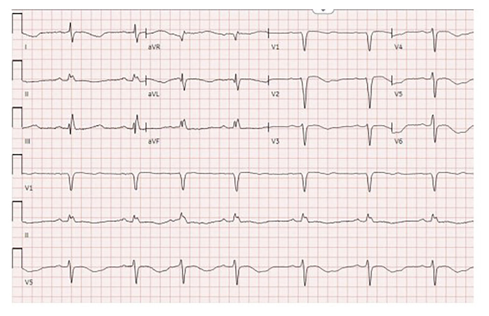 Electrocardiogram showing prolonged QTC interval.