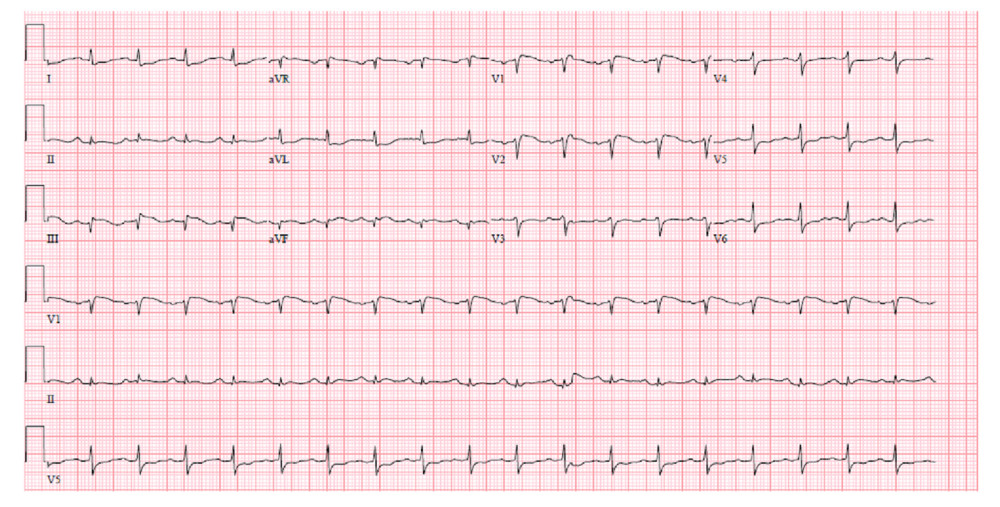 Electrocardiogram shows sinus tachycardia and nonspecific ST-T repolarization abnormalities.